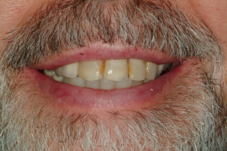 smile before ceramic crowns