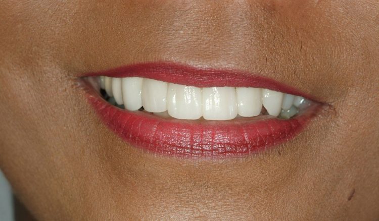 smile with temporary crowns