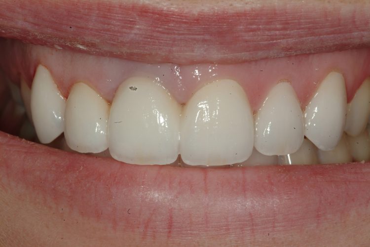 smile after ceramic bridge