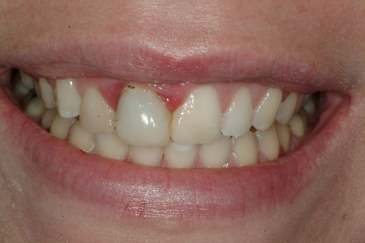 smile before ceramic bridge