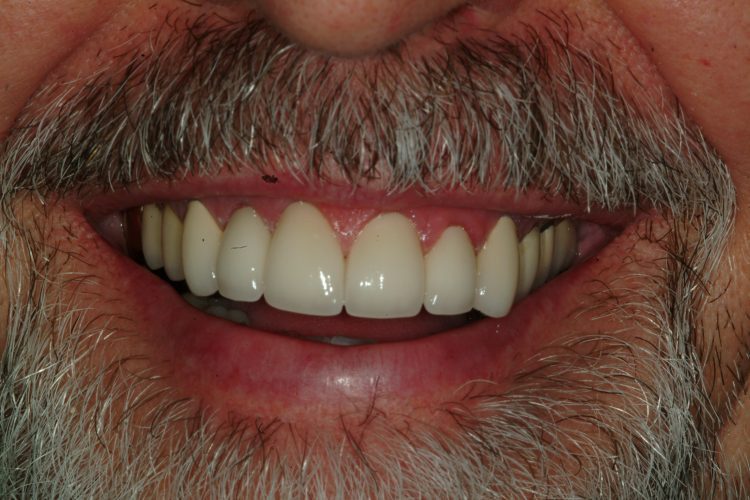 smile after ceramic crowns