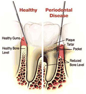 perio disease