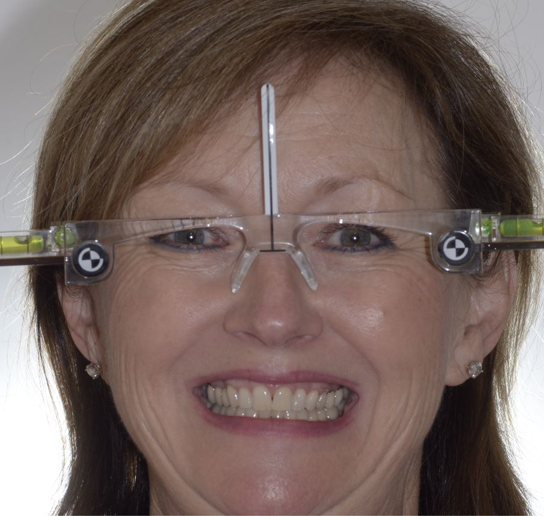 Woman smiling with yellow and crooked teeth