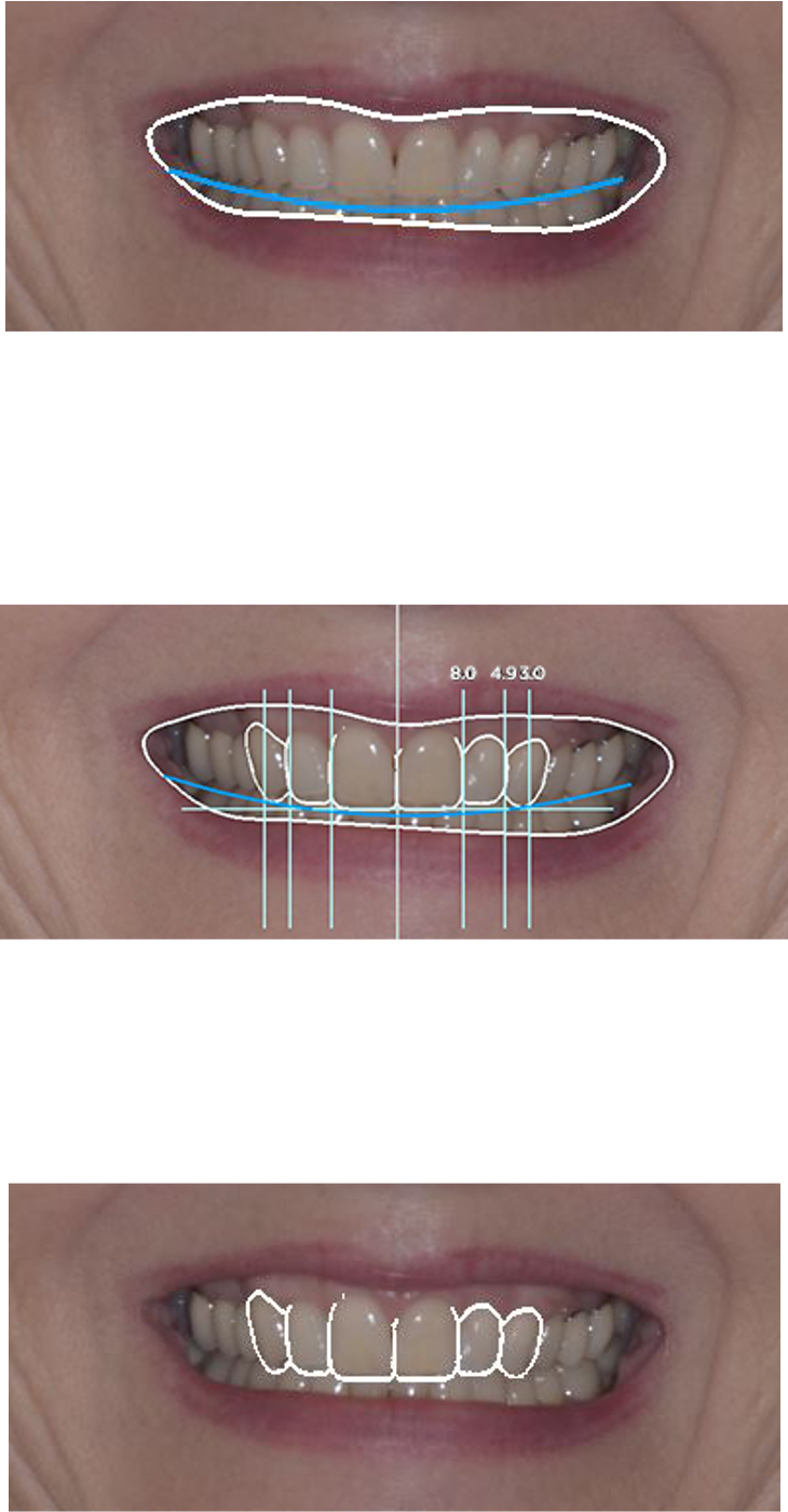 Smile Design process to visualize new smile