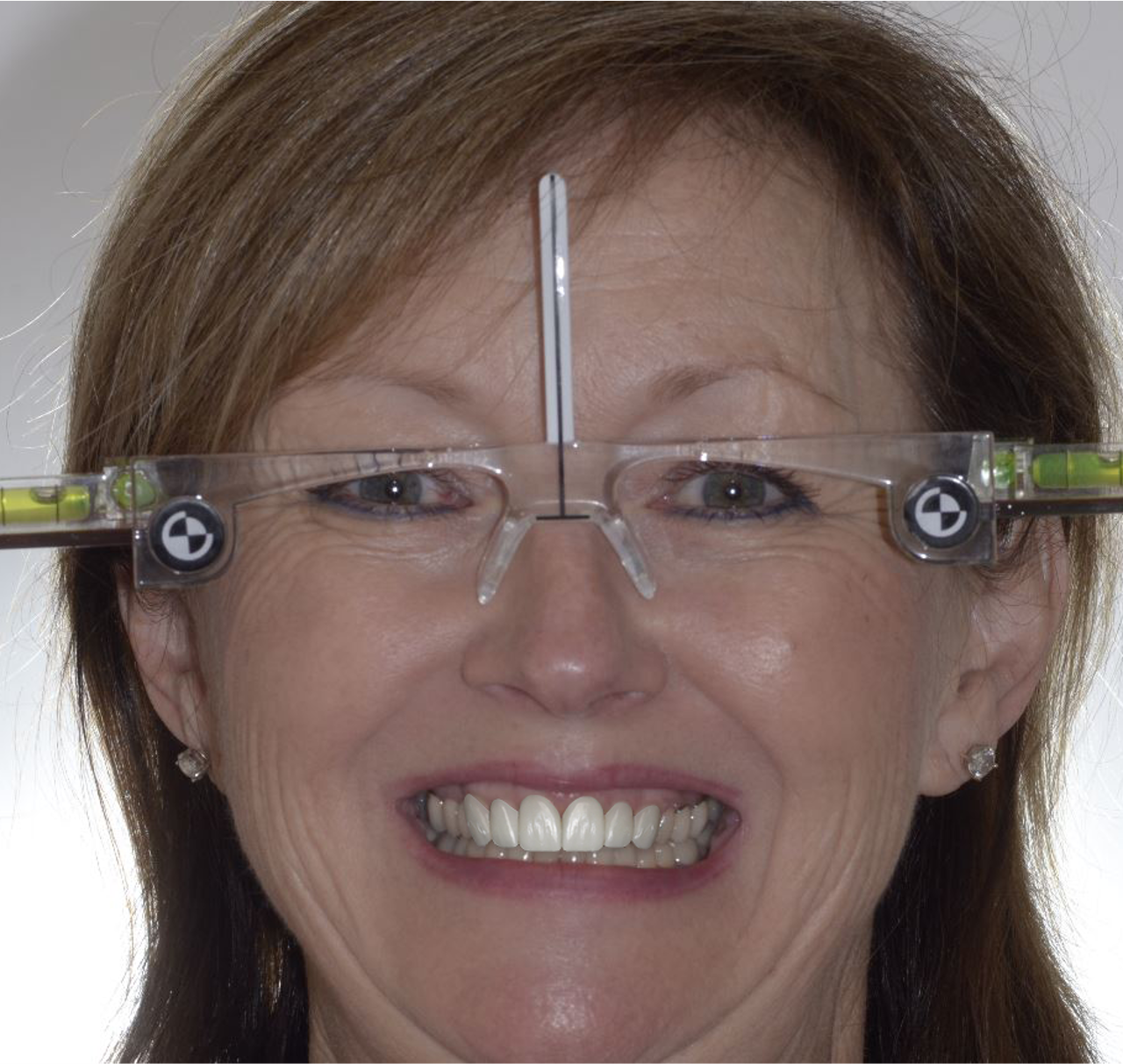 Smile Design proposal showcasing new smile