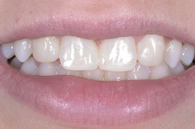 smile after diastema closure