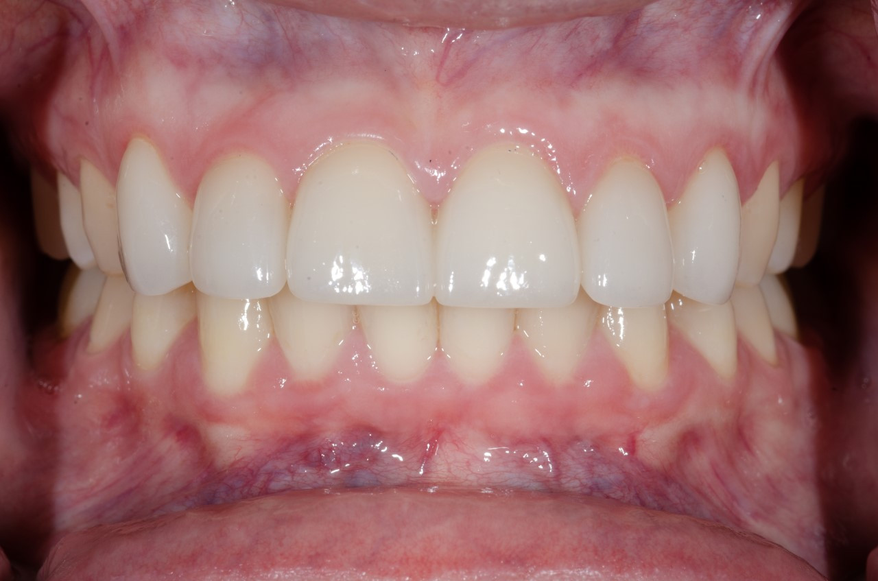 smile after crowns following orthodontics