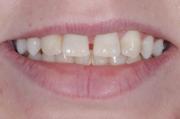 smile before diastema closure