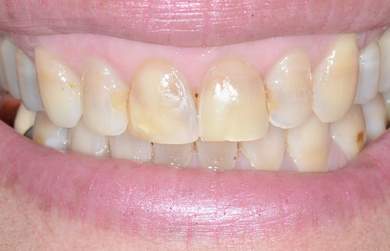 smile before upper and lower crowns