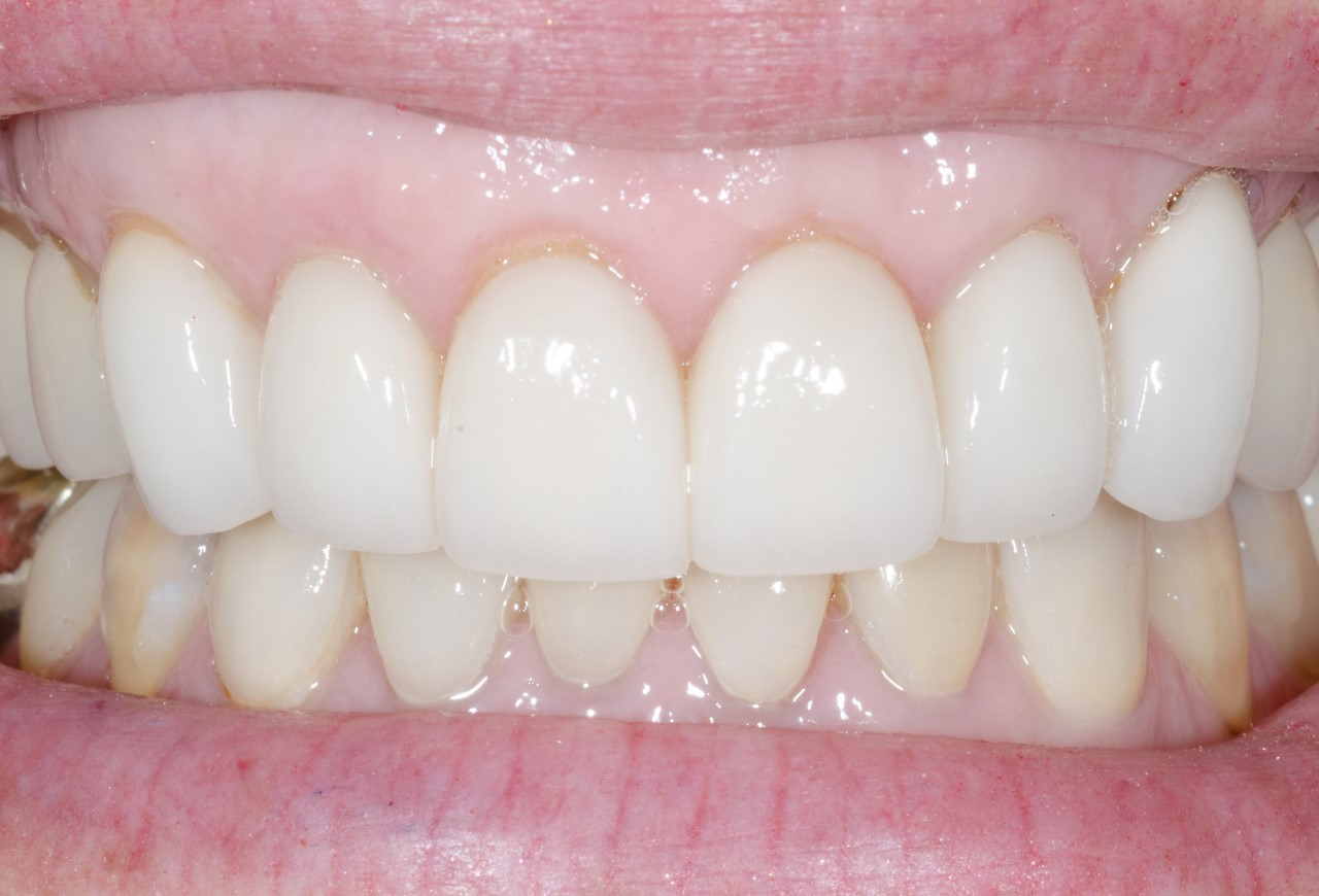 smile after upper and lower crowns